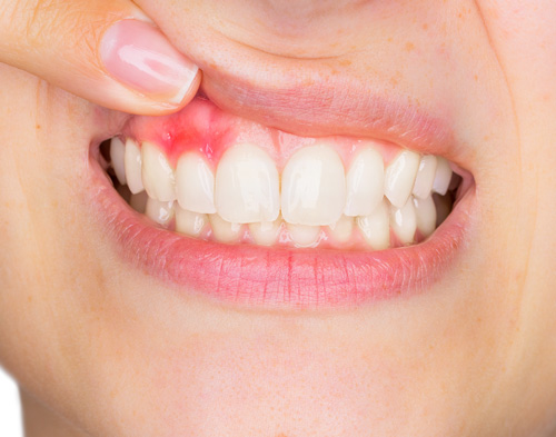 parodontite-milano-2