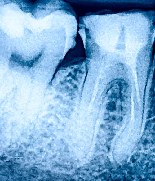 parodontite-milano-3